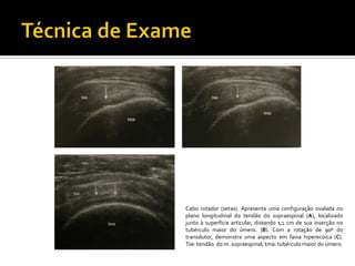 Cabo rotador (setas). Apresenta uma configuração ovalada no
plano longitudinal do tendão do supraespinal (A), localizado
junto à superfície articular, distando 1,1 cm de sua inserção no
tubérculo maior do úmero. (B). Com a rotação de 90º do
transdutor, demonstra uma aspecto em faixa hiperecoica (C).
Tse: tendão do m. supraespinal; tma: tubérculo maior do úmero.
 