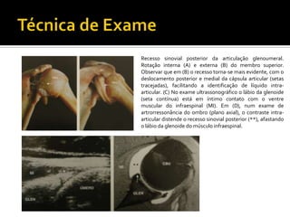 Recesso sinovial posterior da articulação glenoumeral.
Rotação interna (A) e externa (B) do membro superior.
Observar que em (B) o recesso torna-se mais evidente, com o
deslocamento posterior e medial da cápsula articular (setas
tracejadas), facilitando a identificação de líquido intra-
articular. (C) No exame ultrassonográfico o lábio da glenoide
(seta contínua) está em íntimo contato com o ventre
muscular do infraespinal (MI). Em (D), num exame de
artrorressonância do ombro (plano axial), o contraste intra-
articular distende o recesso sinovial posterior (**), afastando
o lábio da glenoide do músculo infraespinal.
 