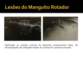 Calcificação na inserção acromial do ligamento coracoacromial (seta). (A)
ultrassonografia; (B) radiografia simples.AC: acrômio; PC: processo coracoide.
 