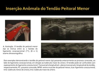 A. Ilustração. O tendão do peitoral menor
(tp) se insinua entre as 2 bandas do
ligamento coracoacromial (**); (B e C)
exame ultrassonográfico.
Dois exemplos demonstrando o tendão do peitoral menor (tp) passando anteriormente ao processo coracoide, ao
lado do ligamento coracoacromial, em direção ao tubérculo maior do úmero. O tendão pode ser confundido com
espessamento do ligamento coracoumeral. Transversal e longitudinal = planos transversal e longitudinal do tendão,
respectivamente; PC: processo coracoide; MPM: ventre muscular do peitoral menor; lcoa: ligamento coracoumeral;
tme: tubérculo menor do úmero; tma: tubérculo maior do úmero.
 