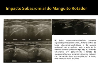 (B) Bolsa subacromial-subdeltóidea esquerda
espessada (entre calipers em B1). Notar o conflito da
bolsa subacromial-subdeltóidea e da gordura
peribursal com o acrômio, após a abdução do
membro superior (setas em B3 e B4); (C) osteófito
subacromial (**) comprimindo o tendão do
supraespinal durante a manobra dinâmica (seta em
C2). Tse: tendão do m. supraespinal; AC: acrômio;
tma: tubérculo maior do úmero.
 
