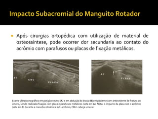  Após cirurgias ortopédica com utilização de material de
osteossíntese, pode ocorrer dor secundaria ao contato do
acrômio com parafusos ou placas de fixação metálicos.
Exame ultrassonográfico em posição neutra (A) e em abdução do braço (B) em paciente com antecedente de fratura do
úmero, sendo realizada fixação com placa e parafusos metálicos (seta em A). Notar o impacto da placa sob o acrômio
(seta em B) durante a manobra dinâmica.AC: acrômio; CBU: cabeça umeral.
 