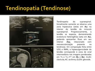 Tendinopatia do supraespinal.
Inicialmente somente se observa uma
zona hipoecoica (setas em A1) no
interior do tendão do músculo
supraespinal. Progressivamente, o
tendão se espessa, demonstrando
ecotextura heterogênea (seta em A2),
podendo apresentar fluxo em seu
interior (A3), relacionado com
neovascularização presente na
tendinose. Em comparação feita entre
USG e RMN, a hipoecogenicidade do
tendão corresponde à zona de sinal
intermediário nas imagens ponderadas
em T1 e T2 (** em B1 e B2). CLAV:
clavícula; AC: acrômio; GLEN: glenoide.
 