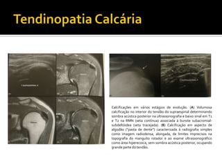 Calcificações em vários estágios de evolução. (A) Volumosa
calcificação no interior do tendão do supraespinal determinando
sombra acústica posterior na ultrassonografia e baixo sinal em T1
e T2 na RMN (seta contínua) associada à bursite subacromial-
subdeltóidea (seta tracejada). (B) Calcificação em aspecto de
algodão (“pasta de dente”) caracterizada à radiografia simples
como imagem radiodensa, alongada, de limites imprecisos na
topografia do manguito rotador e ao exame ultrassonográfico
como área hiperecoica, sem sombra acústica posterior, ocupando
grande parte do tendão.
 