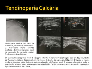 Tendinopatia calcária em fase de
reabsorção, associada à erosão óssea.
(A) Radiografia simples exibindo
calcificação de limites imprecisos (seta)
na topografia do manguito rotador.
Erosão óssea não visibilizada.
(B) Exame ultrassonográfico (modo B e Doppler colorido) demonstrando calcificações (seta em B1), circundadas
por fluxo aumentada ao Doppler colorido no interior do tendão do supraespinal (B2). Em (B3) pode-se notar a
erosão no tubérculo maior do úmero, determinada pelas calcificações (seta). O processo inflamatório acaba se
estendendo, também, para a bolsa subadromial-subdeltóidea (SASD), que se apresenta com paredes espessadas e
líquido em seu interior (seta em B4).
 