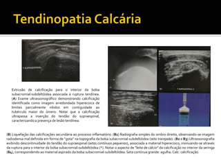 Extrusão de calcificação para o interior da bolsa
subacromial-subdeltóidea associada à ruptura tendínea.
(A) Exame ultrassonográfico demonstrando calcificação
identificada como imagem arredondada hiperecoica de
limites parcialmente nítidos em contiguidade ao
tubérculo maior do úmero. Notar que a calcificação
ultrapassa a inserção do tendão do supraespinal,
caracterizando a presença de lesão tendínea.
(B) Liquefação das calcificações secundária ao processo inflamatório. (B1) Radiografia simples do ombro direito, observando-se imagem
radiodensa mal definida em forma de “gota” na topografia da bolsa subacromial-subdeltóidea (seta tracejada). (B2 e B3) Ultrassonografia
exibindo descontinuidade do tendão do supraespinal (setas contínuas pequenas), associada a material hiperecoico, insinuando-se através
da ruptura para o interior da bolsa subacromial-subdeltóidea (*). Notar o aspecto de “leite de cálcio” da calcificação no interior da seringa
(B4), correspondendo ao material aspirado da bolsa subacromial-subdeltóidea.Seta contínua grande: agulha. Calc: calcificação.
 