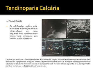4. Pós-calcificação
 As calcificações podem estar
associadas a formações císticas
intratendíneas ou como
pequenos focos hiperecoicos de
limites bem definidos, sem
sombra acústica posterior.
Calcificações associada a formações císticas. (A) Radiografia simples demonstrando calcificações de limites bem
definidos na topografia do manguito rotador. (B) Ultrassonografia (modo B e Doppler colorido) evidenciando
calcificações (setas) no interior do tendão do supraespinal com imagens císticas adjacentes (**), acompanhadas
por fluxo aumentado no Doppler colorido ao seu redor.
 
