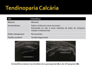 TEC Distróficas
Maiores Menores
Intratendíneas Sobre o tubérculo maior do úmero.
Associadas ou não a sinais indiretos de lesão do manguito
rotador e osteoartrose
Podem desaparecer Permanentes
Tendão saudável Tendão degenerado
Entesófitos (setas) nos tendões do supraespinal (A) e do infraespinal (B).
 