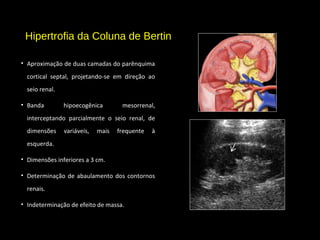 Hipertrofia da Coluna de Bertin
• Aproximação de duas camadas do parênquima
cortical septal, projetando-se em direção ao
seio renal.
• Banda hipoecogênica mesorrenal,
interceptando parcialmente o seio renal, de
dimensões variáveis, mais frequente à
esquerda.
• Dimensões inferiores a 3 cm.
• Determinação de abaulamento dos contornos
renais.
• Indeterminação de efeito de massa.
 