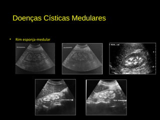 Doenças Císticas Medulares
• Rim esponja-medular
 
