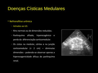 Doenças Císticas Medulares
• Nefronoftise urêmica
- Achados ao US:
- Rins normais ou de dimensões reduzidas.
- Parênquima afilado, hiperecogênico e
perda da diferenciação corticomedular.
- Os cistos na medular, córtex e na junção
corticomedular (< 2 cm) – diminutas
dimensões - podendo-se observar apenas a
hiperecogenicidade difusa do parênquima
renal.
 