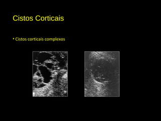 Cistos Corticais
• Cistos corticais complexos
 