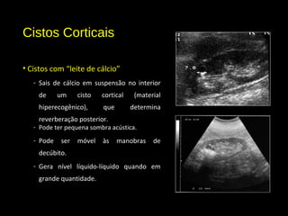 Cistos Corticais
• Cistos com “leite de cálcio”
- Sais de cálcio em suspensão no interior
de um cisto cortical (material
hiperecogênico), que determina
reverberação posterior.
- Pode ter pequena sombra acústica.
- Pode ser móvel às manobras de
decúbito.
- Gera nível líquido-líquido quando em
grande quantidade.
 