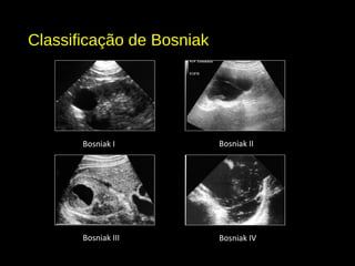 Classificação de Bosniak
Bosniak I Bosniak II
Bosniak III Bosniak IV
 