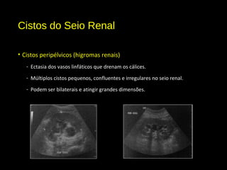 Cistos do Seio Renal
• Cistos peripélvicos (higromas renais)
- Ectasia dos vasos linfáticos que drenam os cálices.
- Múltiplos cistos pequenos, confluentes e irregulares no seio renal.
- Podem ser bilaterais e atingir grandes dimensões.
 