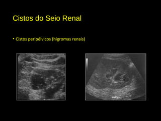 Cistos do Seio Renal
• Cistos peripélvicos (higromas renais)
 