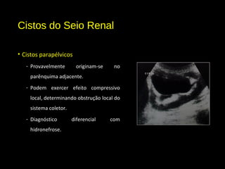 Cistos do Seio Renal
• Cistos parapélvicos
- Provavelmente originam-se no
parênquima adjacente.
- Podem exercer efeito compressivo
local, determinando obstrução local do
sistema coletor.
- Diagnóstico diferencial com
hidronefrose.
 