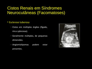 Cistos Renais em Síndromes
Neurocutâneas (Facomatoses)
• Esclerose tuberosa
- Cistos em múltiplos órgãos (fígado,
rins e pâncreas).
- Geralmente múltiplos, de pequenas
dimensões.
- Angiomiolipomas podem estar
presentes.
 