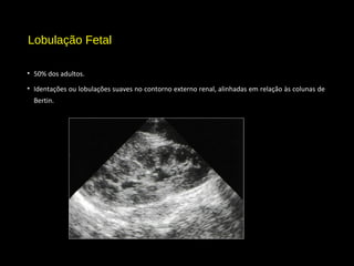 Lobulação Fetal
• 50% dos adultos.
• Identações ou lobulações suaves no contorno externo renal, alinhadas em relação às colunas de
Bertin.
 