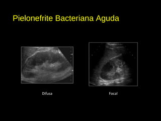 Pielonefrite Bacteriana Aguda
Difusa Focal
 
