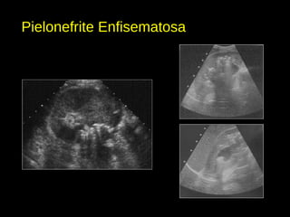 Pielonefrite Enfisematosa
 