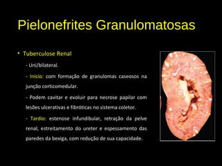 Pielonefrites Granulomatosas
• Tuberculose Renal
- Uni/bilateral.
- Inicio: com formação de granulomas caseosos na
junção corticomedular.
- Podem cavitar e evoluir para necrose papilar com
lesões ulcerativas e fibróticas no sistema coletor.
- Tardio: estenose infundibular, retração da pelve
renal, estreitamento do ureter e espessamento das
paredes da bexiga, com redução de sua capacidade.
 