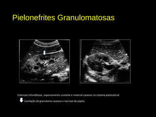 Pielonefrites Granulomatosas
Estenose infundibular, espessamento urotelial e material caseoso no sistema pielocalicial
Cavitação de granuloma caseoso e necrose de papila.
 