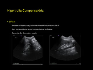 Hipertrofia Compensatória
• Difusa:
- Rim remanescente de pacientes com nefrectomia unilateral.
- Rim preservado de perda funcional renal unilateral.
- Aumento das dimensões renais.
 