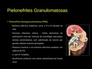 Pielonefrites Granulomatosas
• Pielonefrite Xantogranulomatosa (PNX)
- Mulheres (4M:1H), diabéticas, entre a 5ª e 6ª décadas de
vida.
- Processo infeccioso crônico - lesões destrutivas do
parênquima renal por acúmulo de macrófagos espumosos
(células xantomatosas), com substituição do mesmo por
grandes nódulos amarelo-alaranjados.
- Resposta incomum a um processo obstrutivo qualquer, em
vigência de ITU.
- E. coli e P. mirabillis.
- Geralmente unilateral, com perda subtotal/total da função
renal.
 