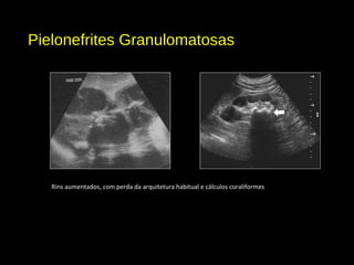 Pielonefrites Granulomatosas
Rins aumentados, com perda da arquitetura habitual e cálculos coraliformes
 