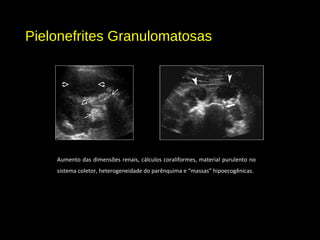 Pielonefrites Granulomatosas
Aumento das dimensões renais, cálculos coraliformes, material purulento no
sistema coletor, heterogeneidade do parênquima e “massas” hipoecogênicas.
 