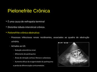 Pielonefrite Crônica
• É uma causa de nefropatia terminal
• Distúrbio túbulo-intersticial crônico.
• Pielonefrite crônica obstrutiva:
- Processos infecciosos renais recidivantes, associados ao quadro de obstrução
urinária.
- Achados ao US:
- Redução volumétrica renal.
- Afilamento de parênquima
- Áreas de retração cortical, fibrose e caliectasia.
- Aumento difuso da ecogenicidade do parênquima
e perda da diferenciação corticomedular.
 
