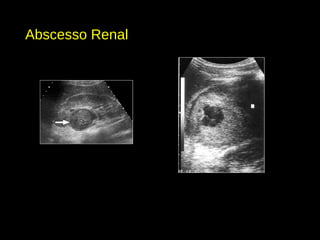 Abscesso Renal
 