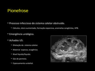 Pionefrose
• Processo infeccioso do sistema coletor obstruído.
• Cálculos, útero aumentado, formação expansiva, anomalias congênitas, HPB.
• Emergência urológica.
• Achados US:
• Dilatação do sistema coletor.
• Material espesso, ecogênico.
• Nível líquido/líquido.
• Gás de permeio.
• Espessamento urotelial.
 