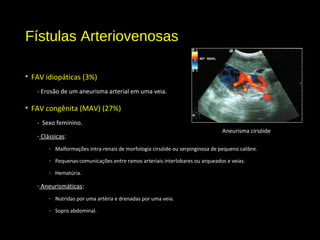 Fístulas Arteriovenosas
• FAV idiopáticas (3%)
- Erosão de um aneurisma arterial em uma veia.
• FAV congênita (MAV) (27%)
- Sexo feminino.
- Clássicas:
- Malformações intra-renais de morfologia cirsóide ou serpinginosa de pequeno calibre.
- Pequenas comunicações entre ramos arteriais interlobares ou arqueados e veias.
- Hematúria.
- Aneurismáticas:
- Nutridas por uma artéria e drenadas por uma veia.
- Sopro abdominal.
Aneurisma cirsóide
 