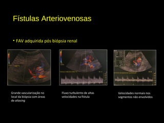 Fístulas Arteriovenosas
• FAV adquirida pós biópsia renal
Grande vascularização no
local da biópsia com áreas
de aliasing
Fluxo turbulento de altas
velocidades na fístula
Velocidades normais nos
segmentos não envolvidos
 