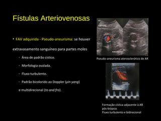 Fístulas Arteriovenosas
• FAV adquirida - Pseudo-aneurisma: se houver
extravasamento sanguíneo para partes moles
- Área de padrão cístico.
- Morfologia ovalada.
- Fluxo turbulento.
- Padrão bicolorido ao Doppler (yin-yang)
e multidirecional (to and fro).
Pseudo-aneurisma aterosclerótico de AR
Formação cística adjacente à AR
pós-biópsia.
Fluxo turbulento e bidirecional
 