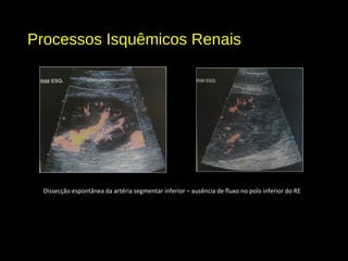 Processos Isquêmicos Renais
Dissecção espontânea da artéria segmentar inferior – ausência de fluxo no polo inferior do RE
 
