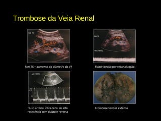 Trombose da Veia Renal
Rim TX – aumento do diâmetro da VR Fluxo venoso por recanalização
Fluxo arterial intra-renal de alta
resistência com diástole reversa
Trombose venosa extensa
 