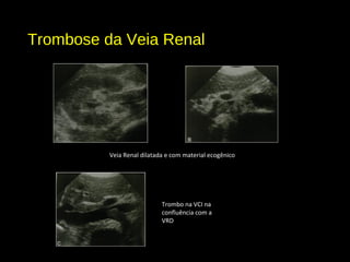 Trombose da Veia Renal
Veia Renal dilatada e com material ecogênico
Trombo na VCI na
confluência com a
VRD
 