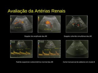 Avaliação da Artérias Renais
Doppler de amplitude das AR Doppler colorido simultâneo das AR
Padrão espectral e velocimétrico normal das AR Corte transversal do abdome em modo B
 