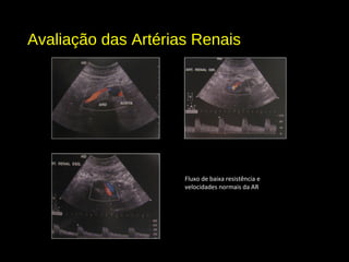 Avaliação das Artérias Renais
Fluxo de baixa resistência e
velocidades normais da AR
 