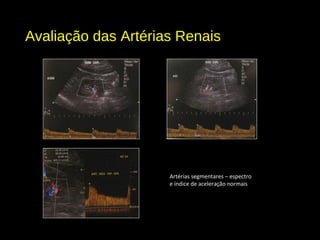 Avaliação das Artérias Renais
Artérias segmentares – espectro
e índice de aceleração normais
 