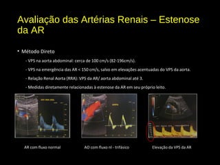 Avaliação das Artérias Renais – Estenose
da AR
• Método Direto
- VPS na aorta abdominal: cerca de 100 cm/s (82-196cm/s).
- VPS na emergência das AR < 150 cm/s, salvo em elevações acentuadas do VPS da aorta.
- Relação Renal Aorta (RRA): VPS da AR/ aorta abdominal até 3.
- Medidas diretamente relacionadas à estenose da AR em seu próprio leito.
Elevação da VPS da ARAR com fluxo normal AO com fluxo nl - trifásico
 