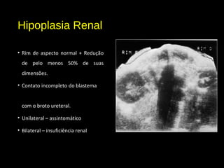 Hipoplasia Renal
• Rim de aspecto normal + Redução
de pelo menos 50% de suas
dimensões.
• Contato incompleto do blastema
com o broto ureteral.
• Unilateral – assintomático
• Bilateral – insuficiência renal
 