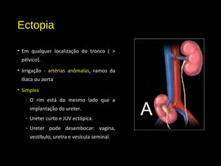 Ectopia
• Em qualquer localização do tronco ( >
pélvico).
• Irrigação - artérias anômalas, ramos da
ilíaca ou aorta
• Simples
- O rim está do mesmo lado que a
implantação do ureter.
- Ureter curto e JUV ectópica.
- Ureter pode desembocar: vagina,
vestíbulo, uretra e vesícula seminal.
 