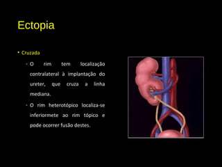 Ectopia
• Cruzada
- O rim tem localização
contralateral à implantação do
ureter, que cruza a linha
mediana.
- O rim heterotópico localiza-se
inferiormete ao rim tópico e
pode ocorrer fusão destes.
 