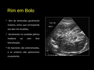 Rim em Bolo
• Rim de dimensões geralmente
maiores, único, que corresponde
aos dois rins fundidos.
• Geralmente na cavidade pélvica
mediana ou com leve
lateralização.
• Os bacinetes são anteriorizados,
e os ureteres não apresentam
cruzamento.
 