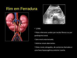 Rim em Ferradura
• 1/400.
• Polos inferiores unidos por tecido fibroso ou por
parênquima renal.
• Seio renal anteriorizado.
• Artérias renais aberrantes.
• Polos renais alongados, de contornos borrados e
uma faixa hipoecogênica anterior à aorta.
 