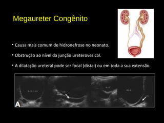 Megaureter Congênito
• Causa mais comum de hidronefrose no neonato.
• Obstrução ao nível da junção ureterovesical.
• A dilatação ureteral pode ser focal (distal) ou em toda a sua extensão.
 